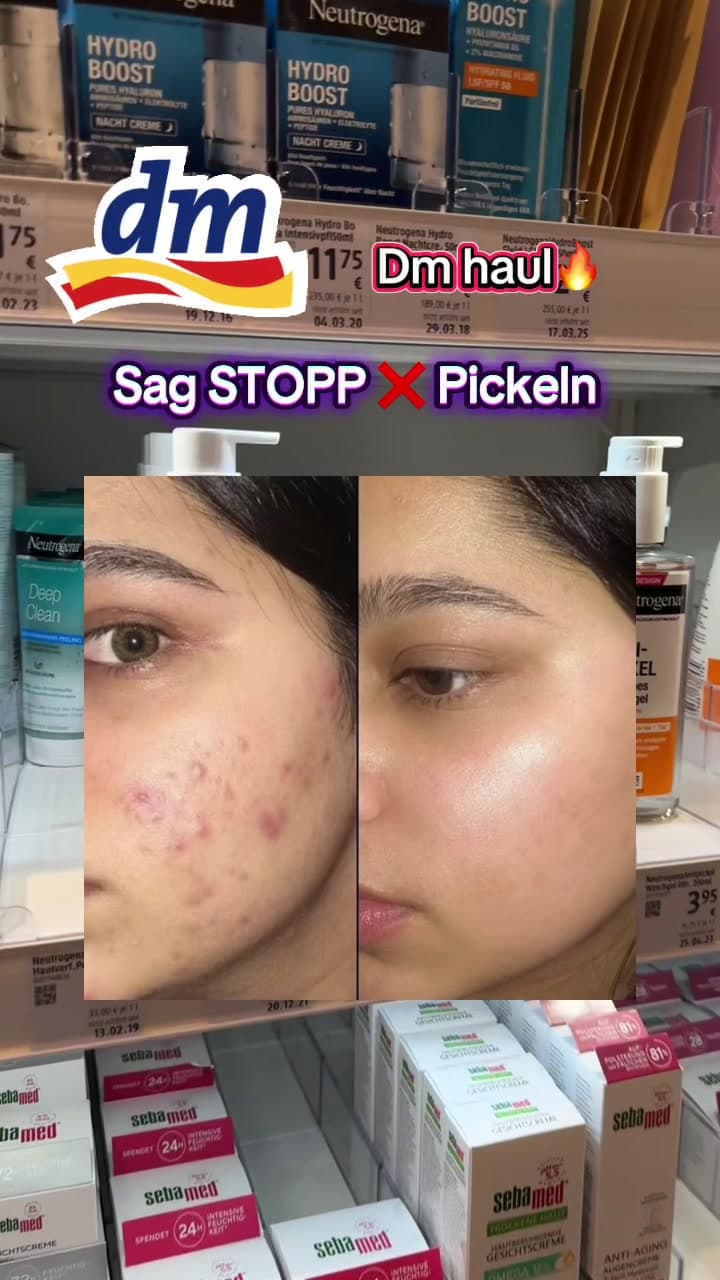 @sofii.guru — Diese Produkte aus dm helfen gegen unreine Haut, Mitesser & fettige Haut! Welches würdet ihr testen? 👀