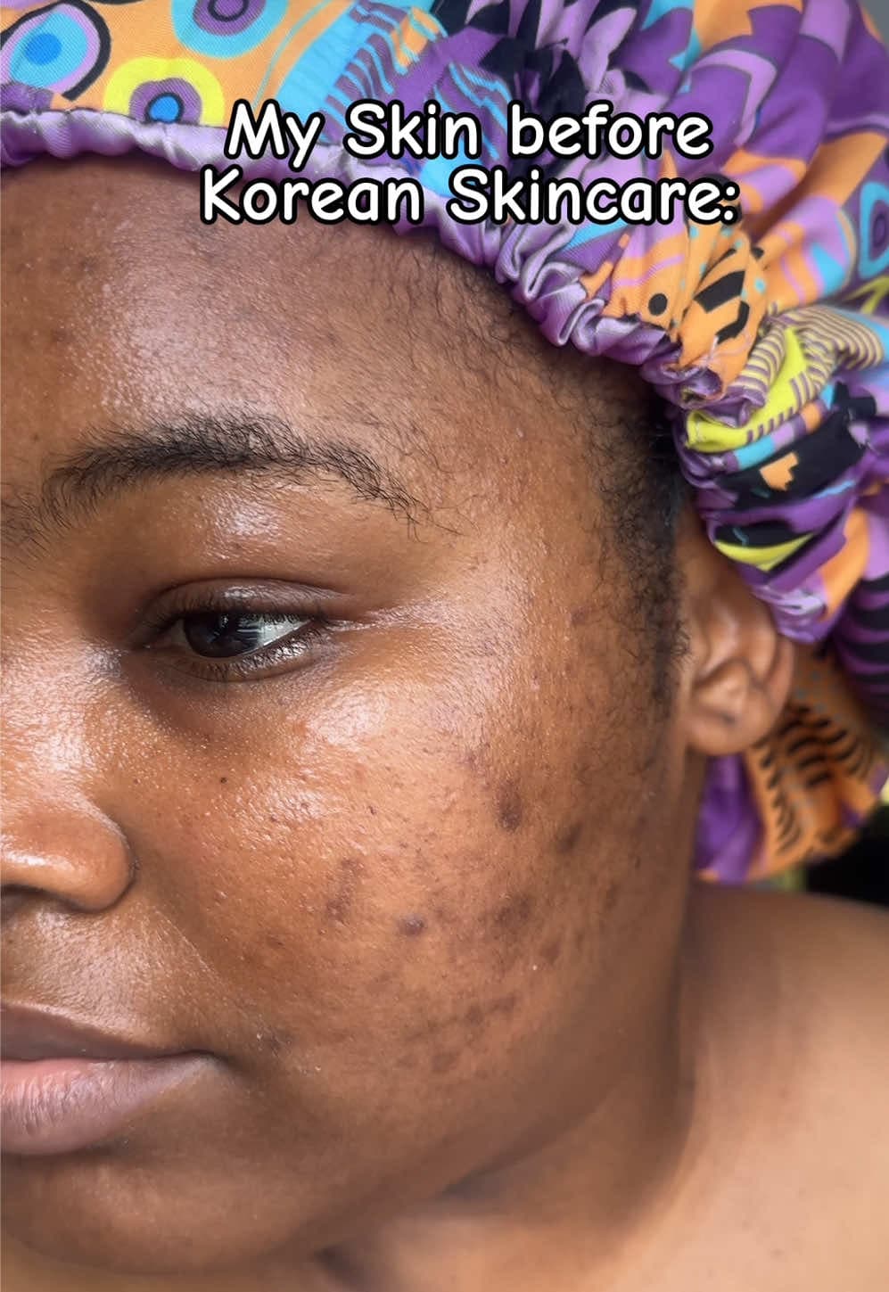 @clevysdiary — #koreanskincare The Korean Skincare Effect! You can see #darkspots #hyperpigmentation #acnescars #skincare @VT Cosmetics US 