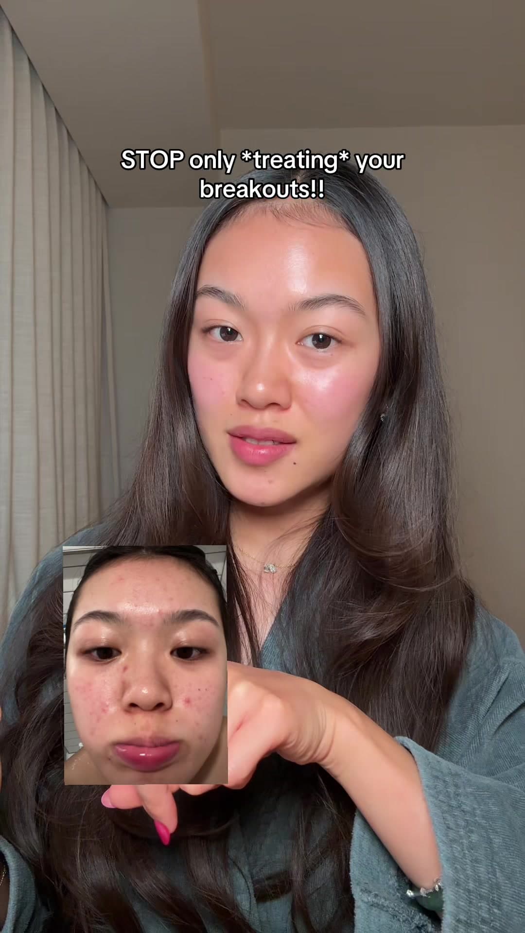 @charinecheungg — you have to break the acne cycle if you want to clear your skin. this azelaic acid serum is FA safe, niacinamide free, targets all causes of acne, inflammation, and helps with evening skin tone after!