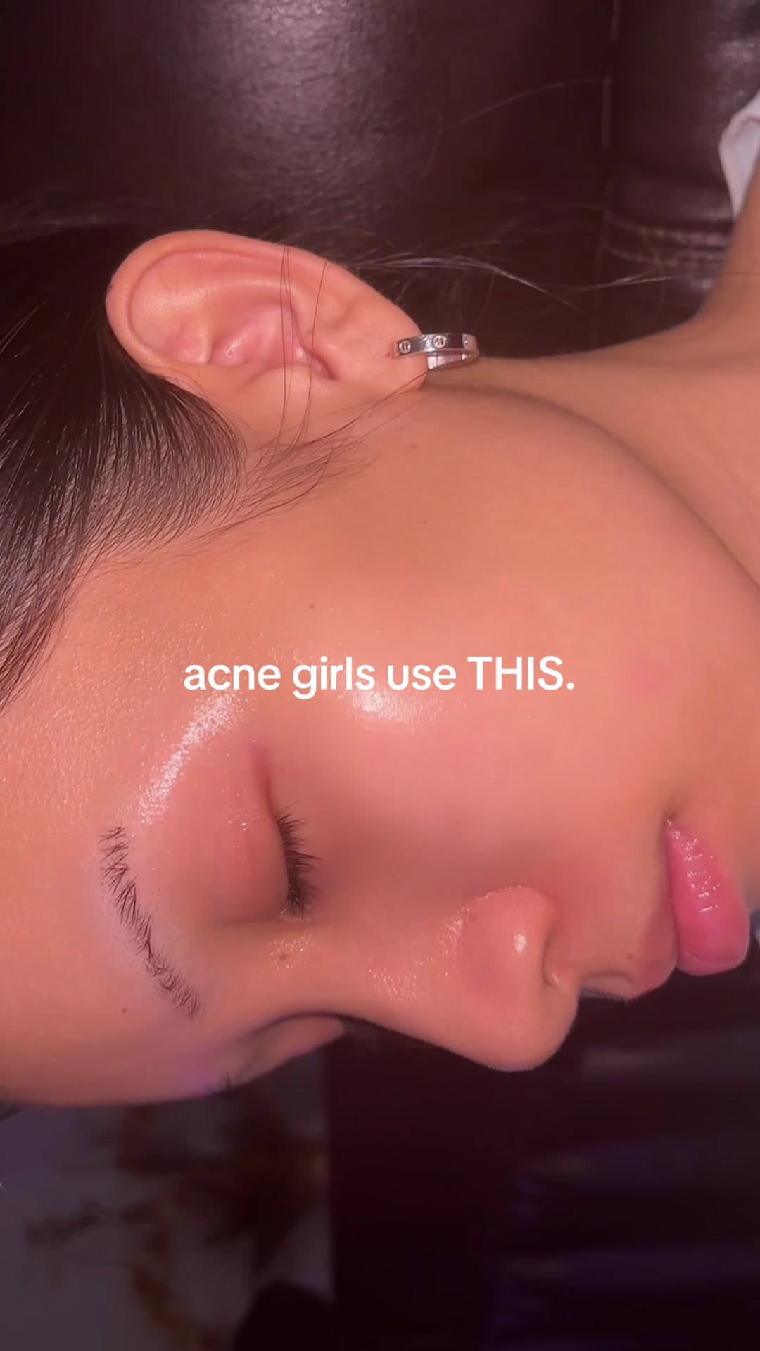 @carewithmi — my acne scars glass skin cheat code. #dralthea #dralthea345cream #clearskin